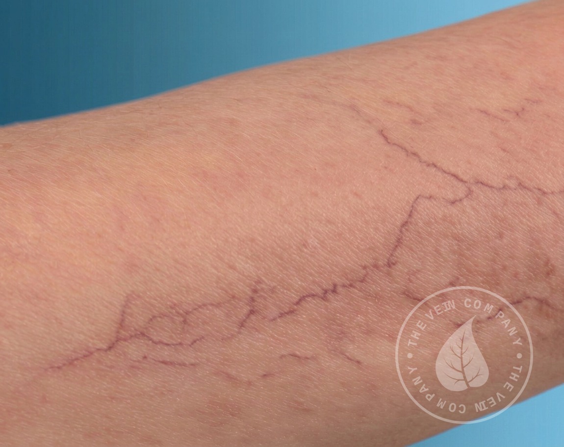新品　VITA-K SPIDER VEINS クモ静脈の外観減、小じわ減少 Spider Vein Treatment | Sclerotherapy | The Vein Company