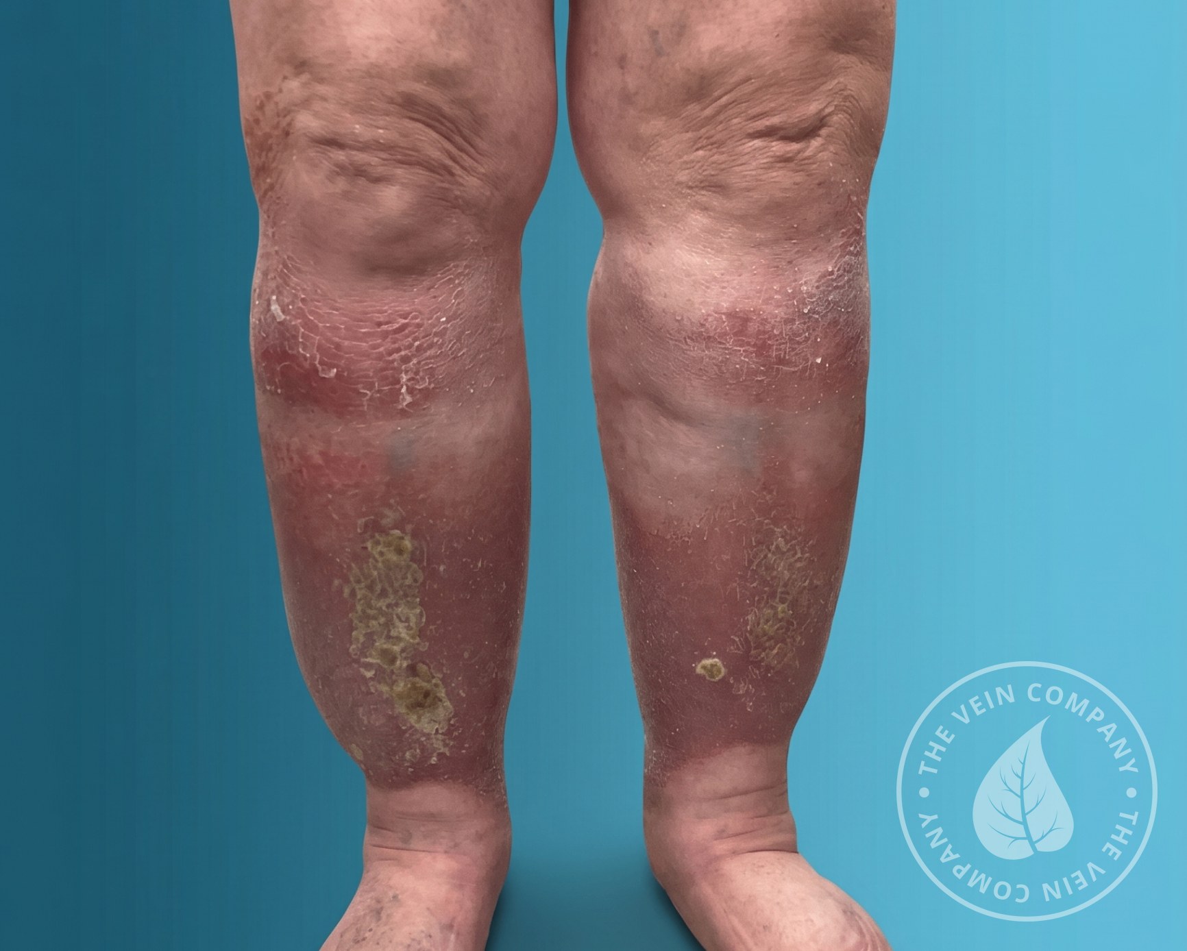 Lower leg wearing a medical compression stocking — a key part of integrated phlebolymphedema treatment.