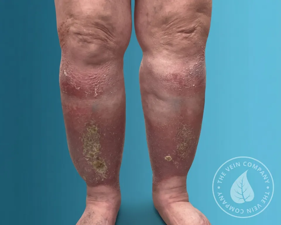 Lower leg wearing a medical compression stocking — a key part of integrated phlebolymphedema treatment.