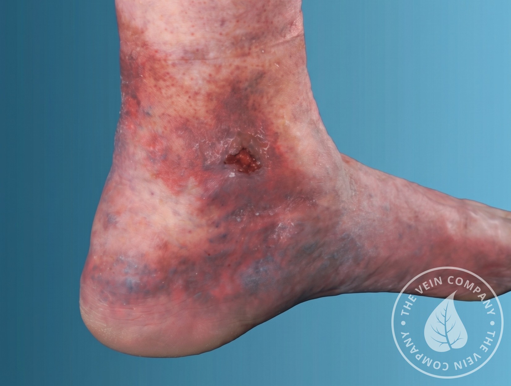 Venous leg ulcer associated with advanced varicose veins.
