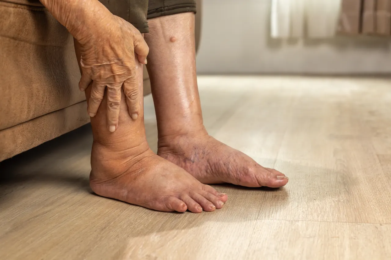 Lower Leg Swelling
