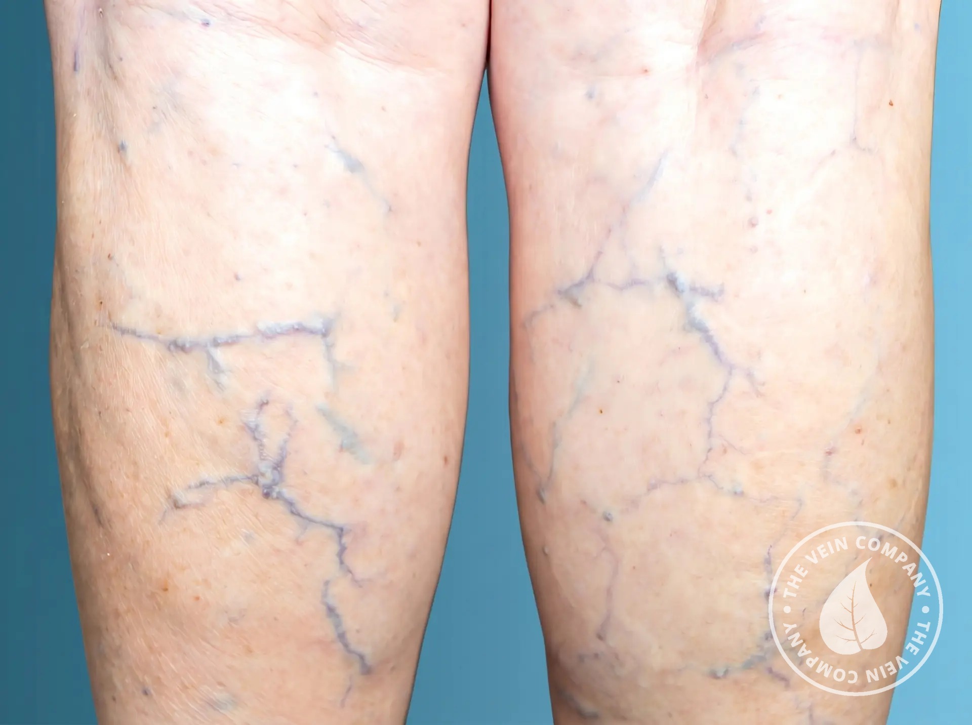 Dark purple or blue varicose veins on the leg.