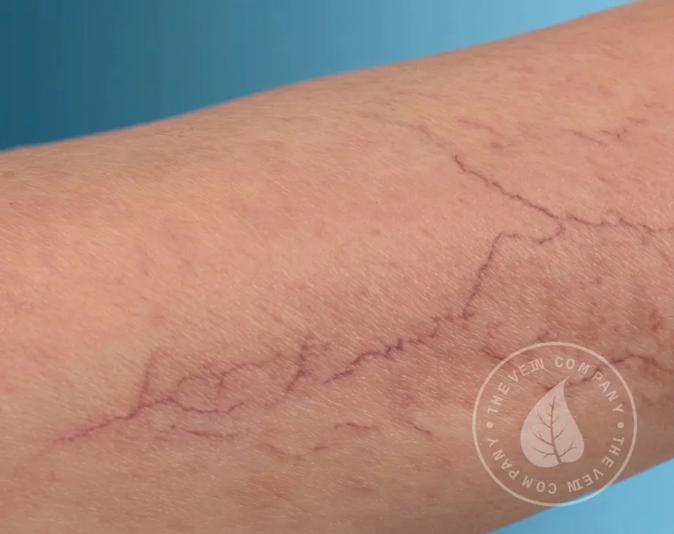 Spider veins on the legs
