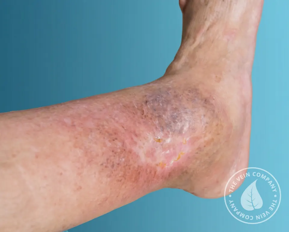 Non-healing venous leg ulcer near the ankle showing dark hyperpigmentation, broken skin, and surrounding inflammation caused by chronic venous insufficiency.