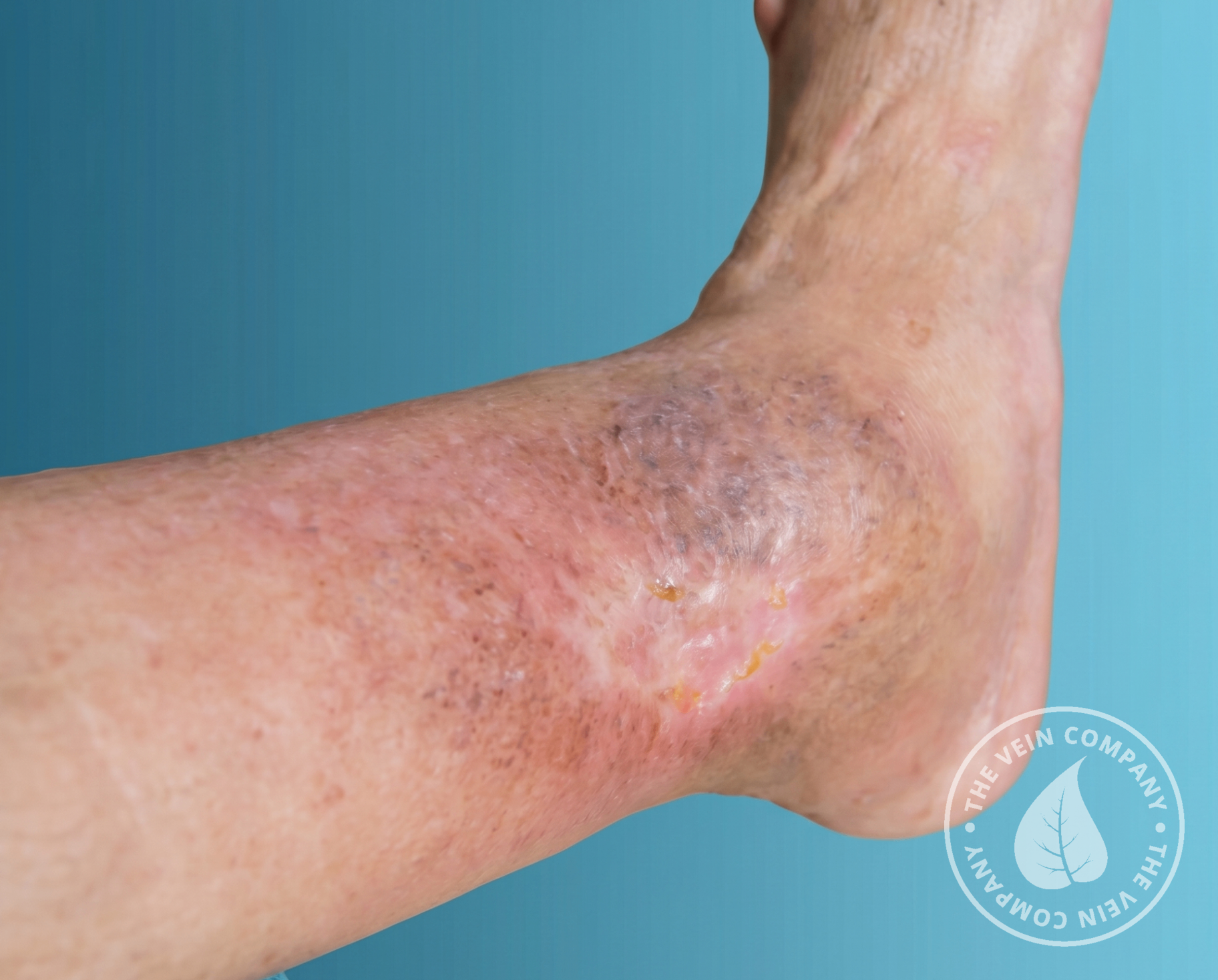 Non-healing venous leg ulcer near the ankle showing dark hyperpigmentation, broken skin, and surrounding inflammation caused by chronic venous insufficiency.