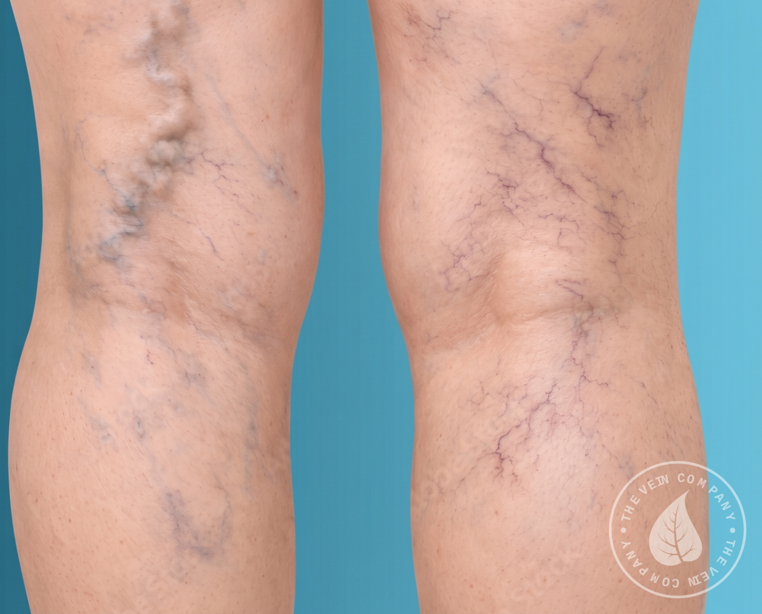 Lower leg showing visible bulging varicose veins, mild ankle swelling, and brown hyperpigmentation caused by chronic venous insufficiency.
