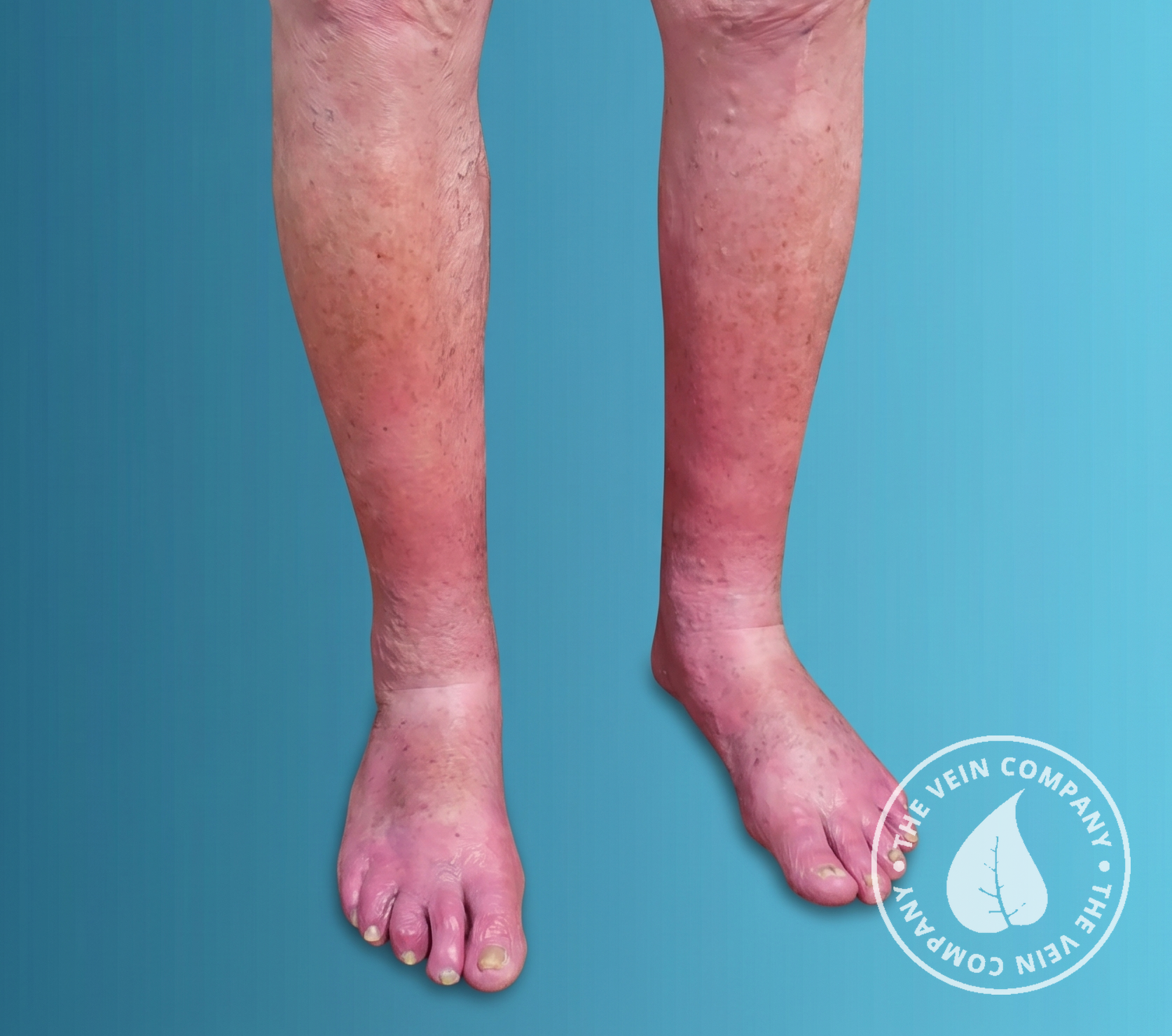 Same patient legs after treatment at The Vein Company showing reduced swelling and improved skin tone