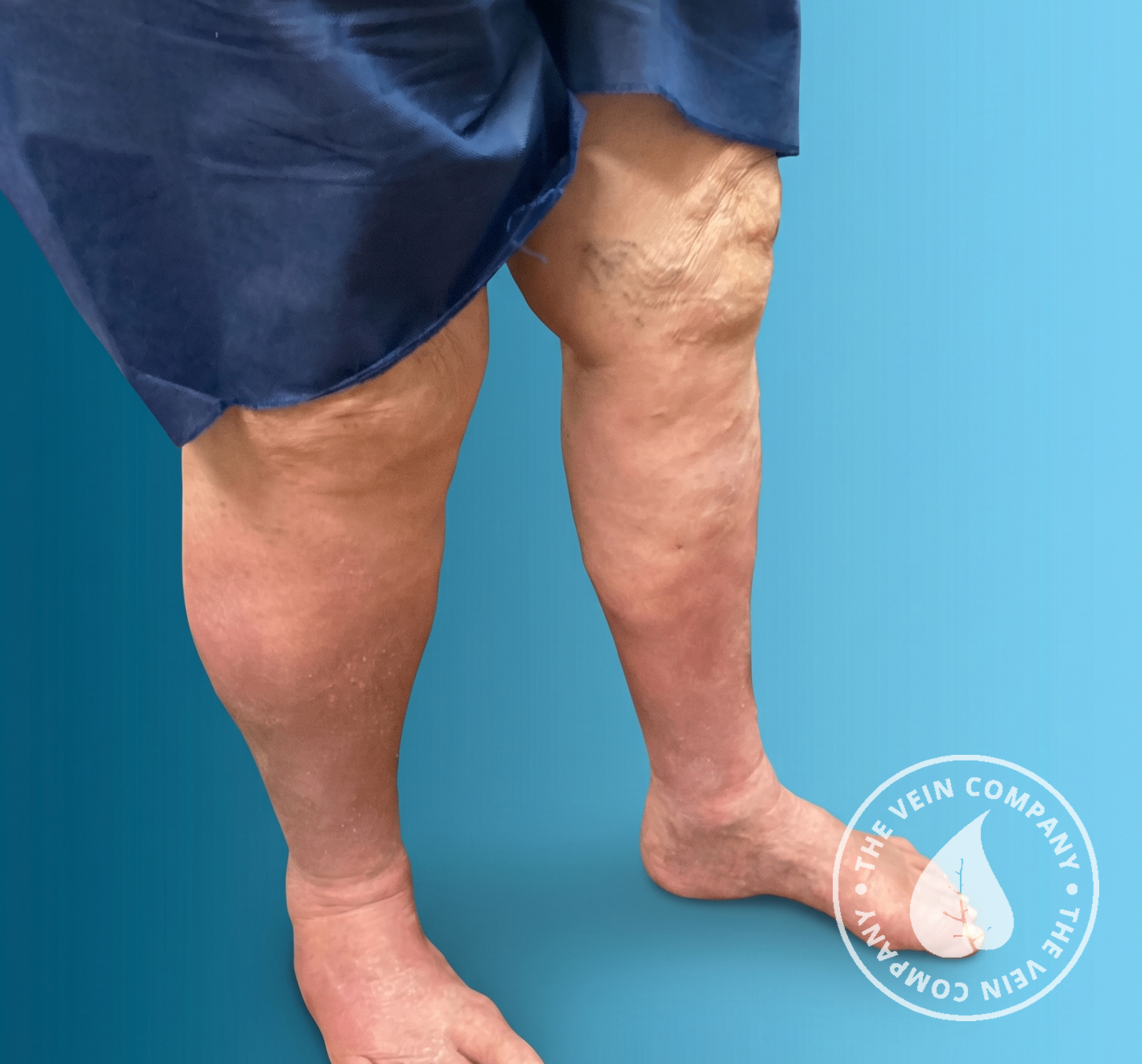 Healed leg following lymphedema treatment at The Vein Company showing closed skin and reduced volume