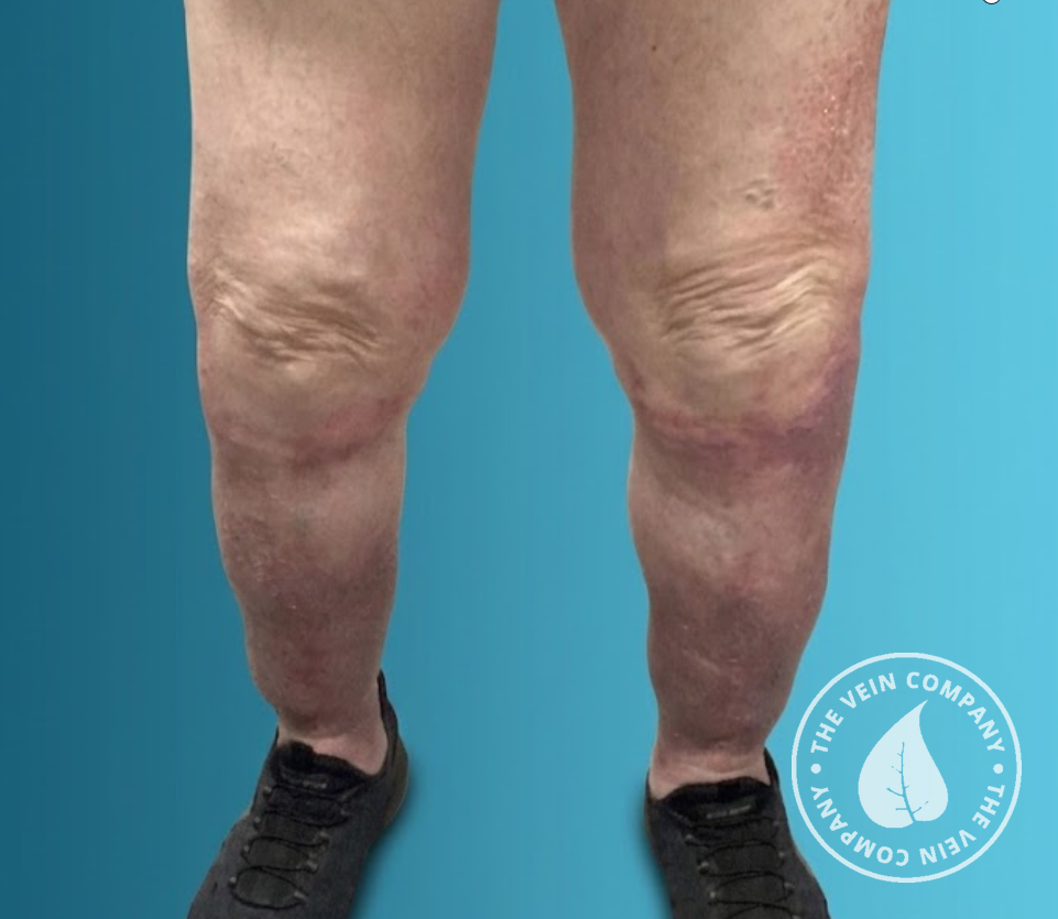 Lower legs with clear, even-toned skin after vein treatment at The Vein Company
