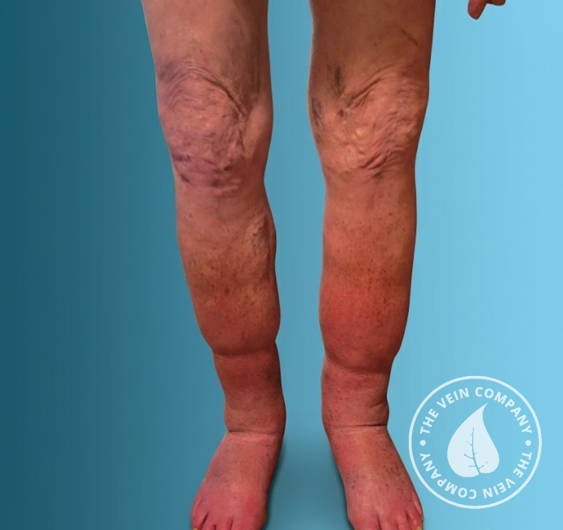 Patient legs before treatment at The Vein Company showing visible varicose veins, swelling, and discoloration