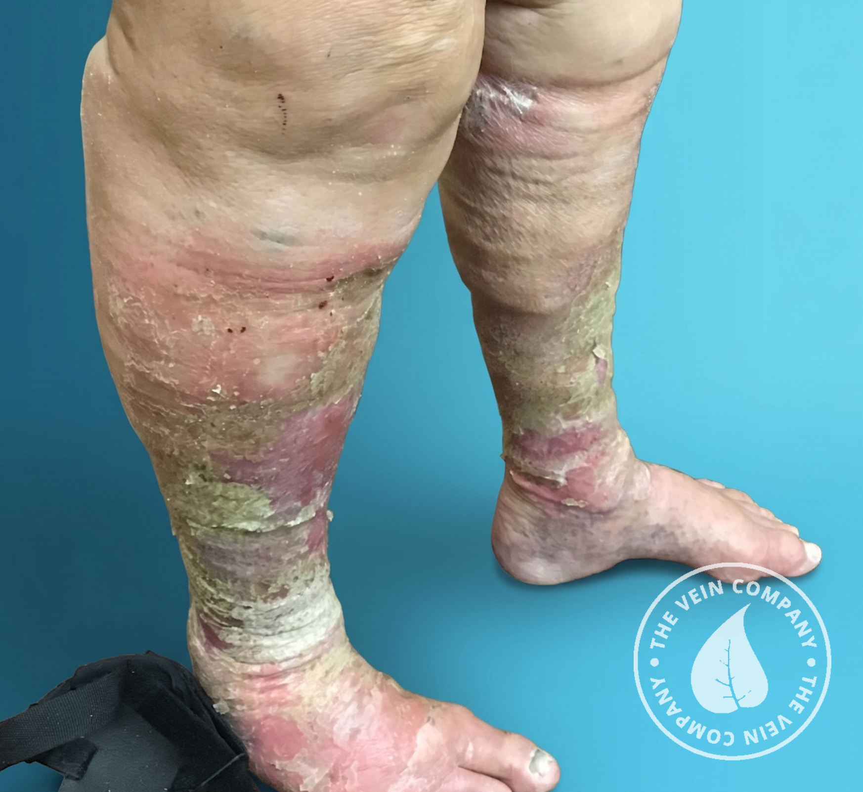 Advanced lymphedema with skin breakdown and weeping wounds before treatment at The Vein Company