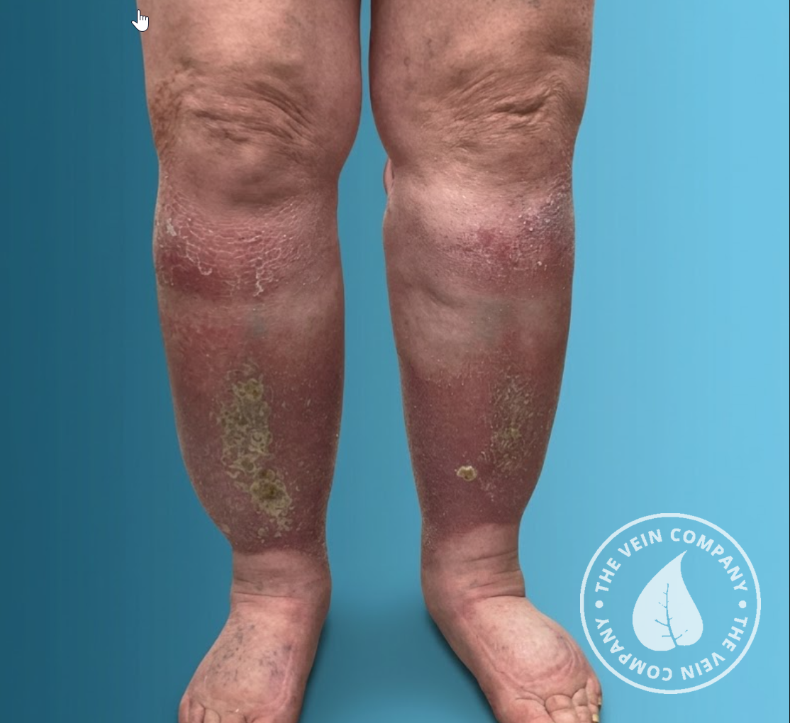 Lower legs with venous stasis dermatitis and eczema-like patches before treatment at The Vein Company