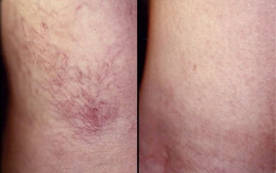 Spider-Vein-before-and-after