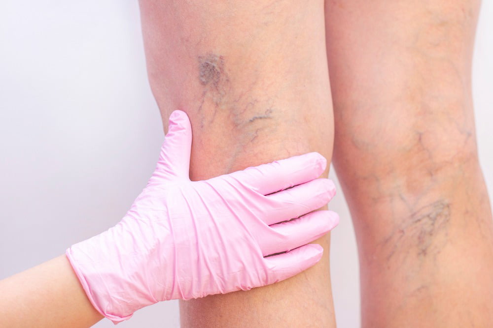 5 Simple Lifestyle Changes That Help Prevent Varicose Veins - The