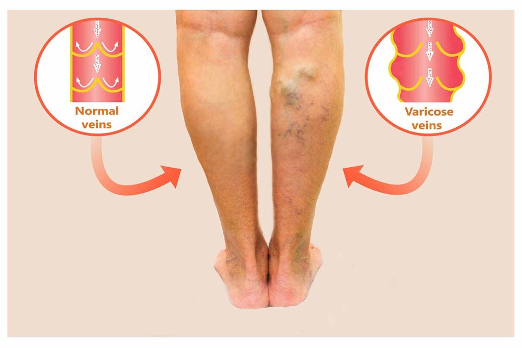 Spider Veins: Understanding the Health Risks and Treatment Options Beyond  Cosmetic Concerns - The Vein Company